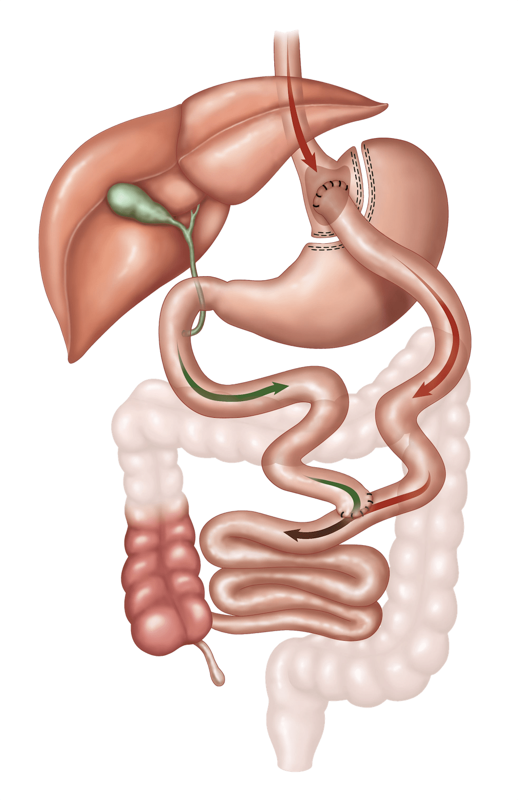 Cirurgia de bypass gástrico